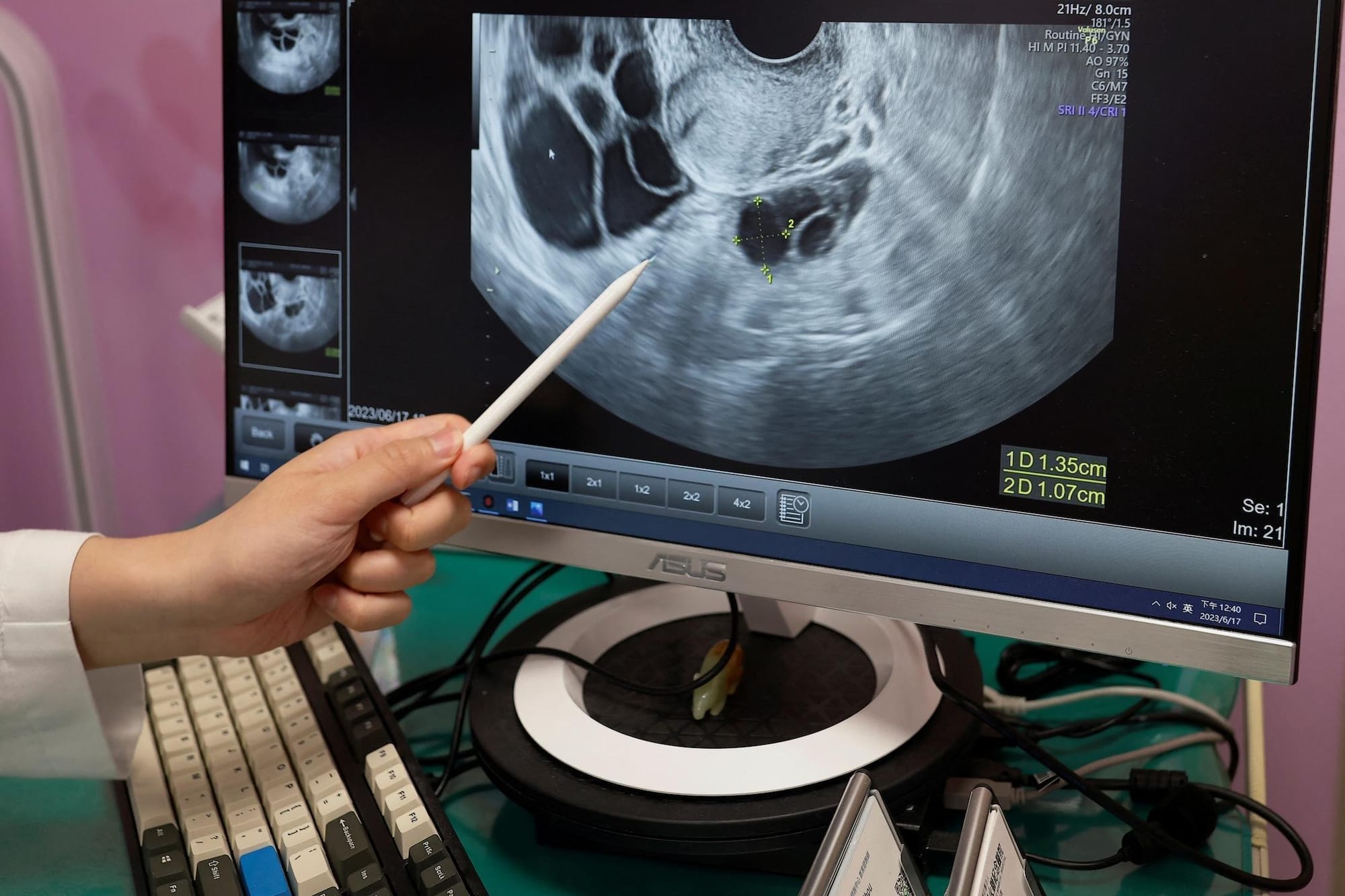How new ovarian cancer findings may help reduce risk