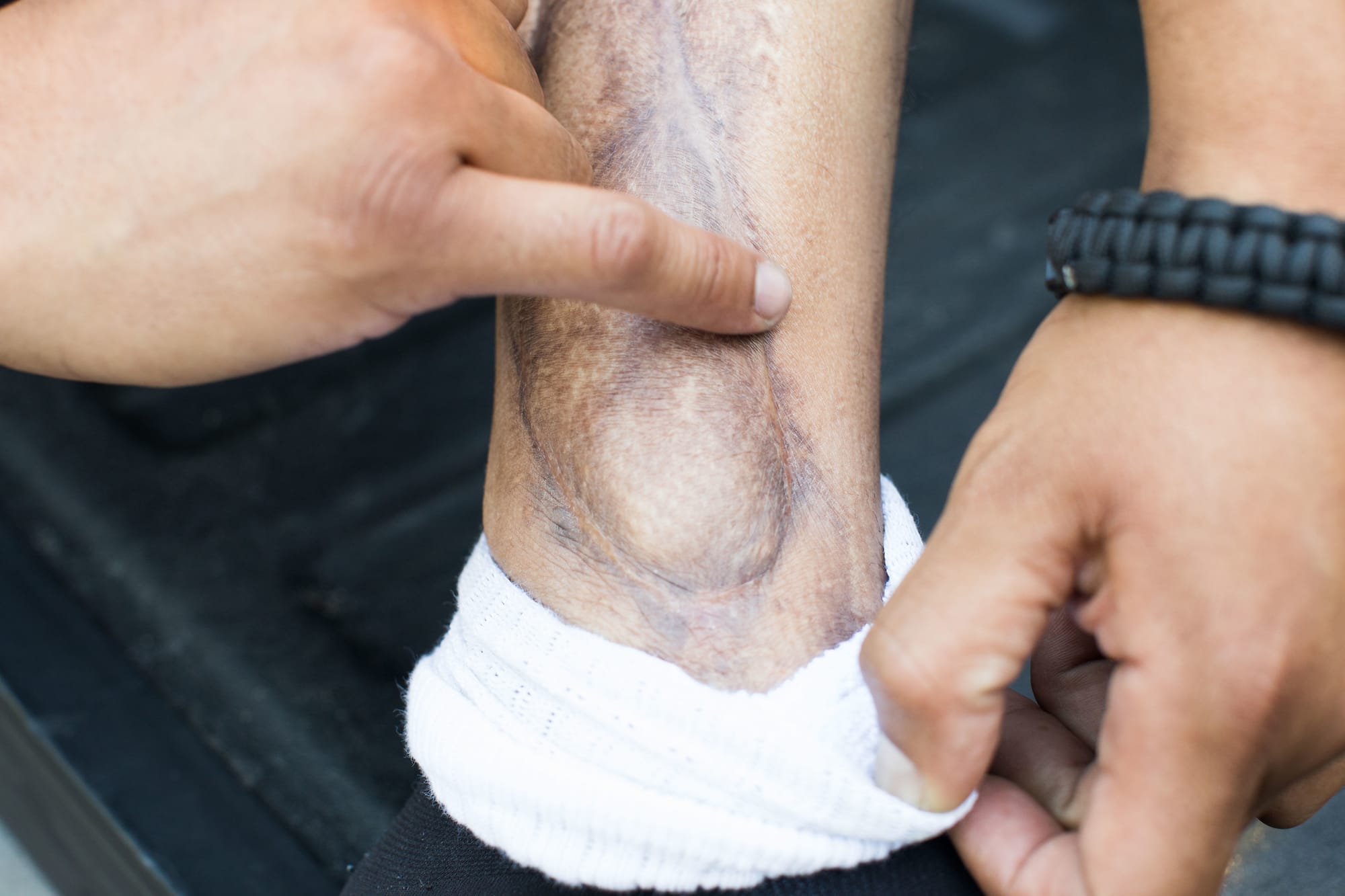 Richard Alvarado shows scars from an injury he sustained, while sitting on the back of his truck where he sleeps in a parking lot near the Veterans Administration in Seattle's Beacon Hill neighborhood, July 17, 2018.