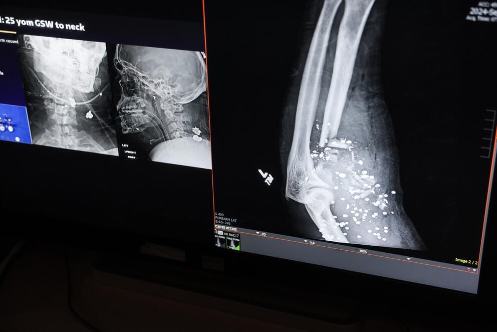 two x-rays showing different gun shot injuries