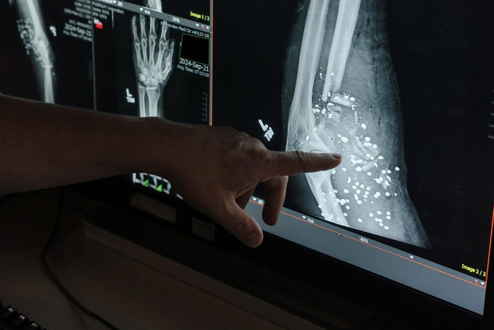 A finger points out the presence buckshot on an x-ray